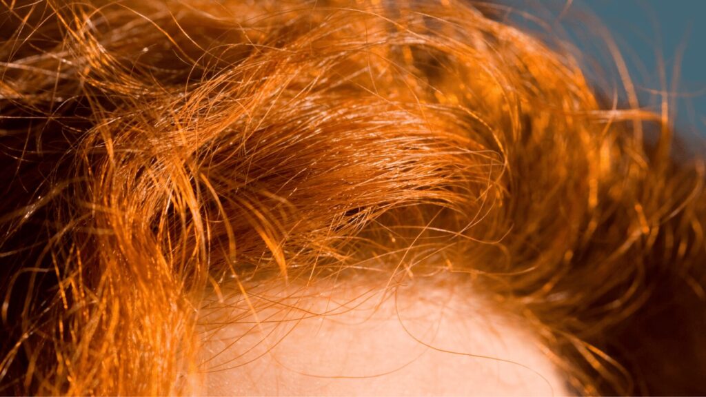 Ce qu'il faut savoir sur l'acné du cuir chevelu et pourquoi les rousses en souffrent