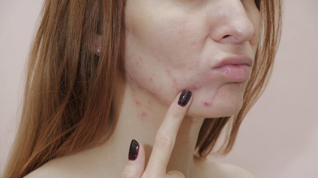 4 façons dont les rousses peuvent lutter contre les boutons aveugles