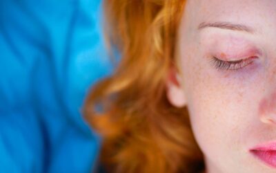 Comment les rousses peuvent corriger les cernes sous les yeux