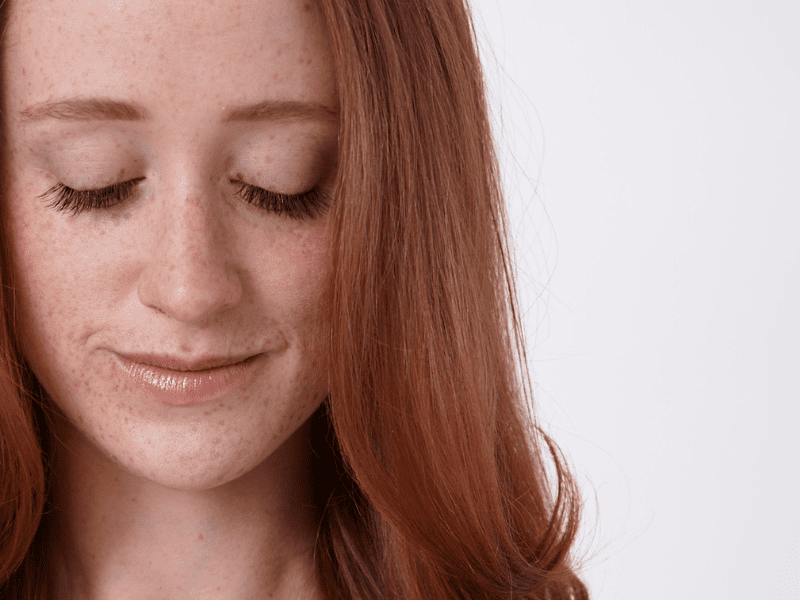 sensitive redhead skin