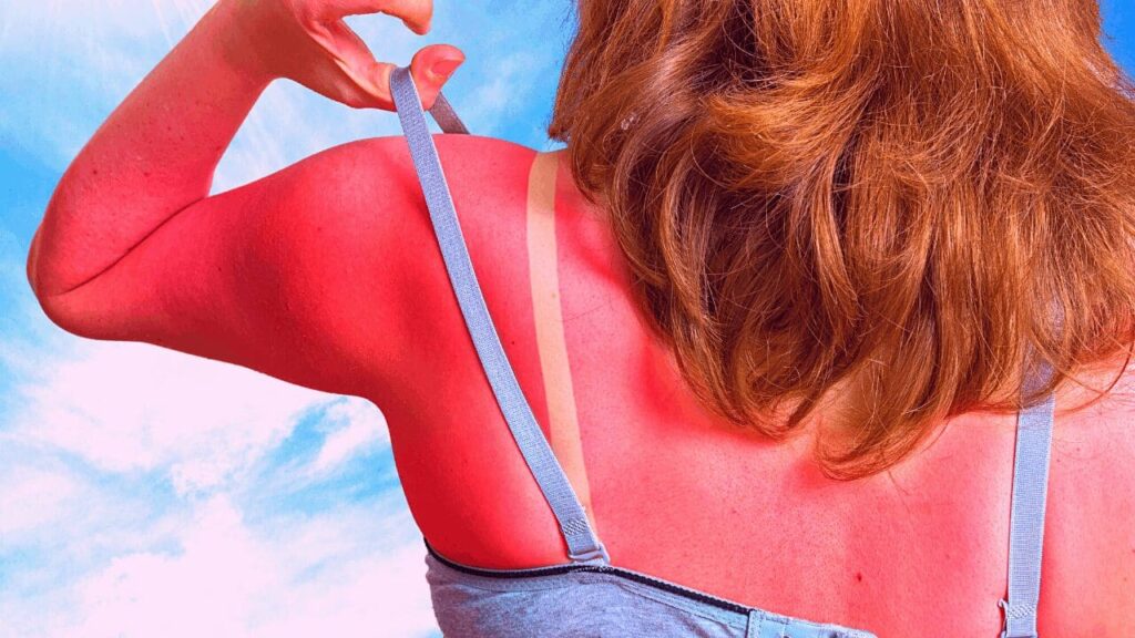 Comment les rousses peuvent traiter rapidement un coup de soleil à la maison